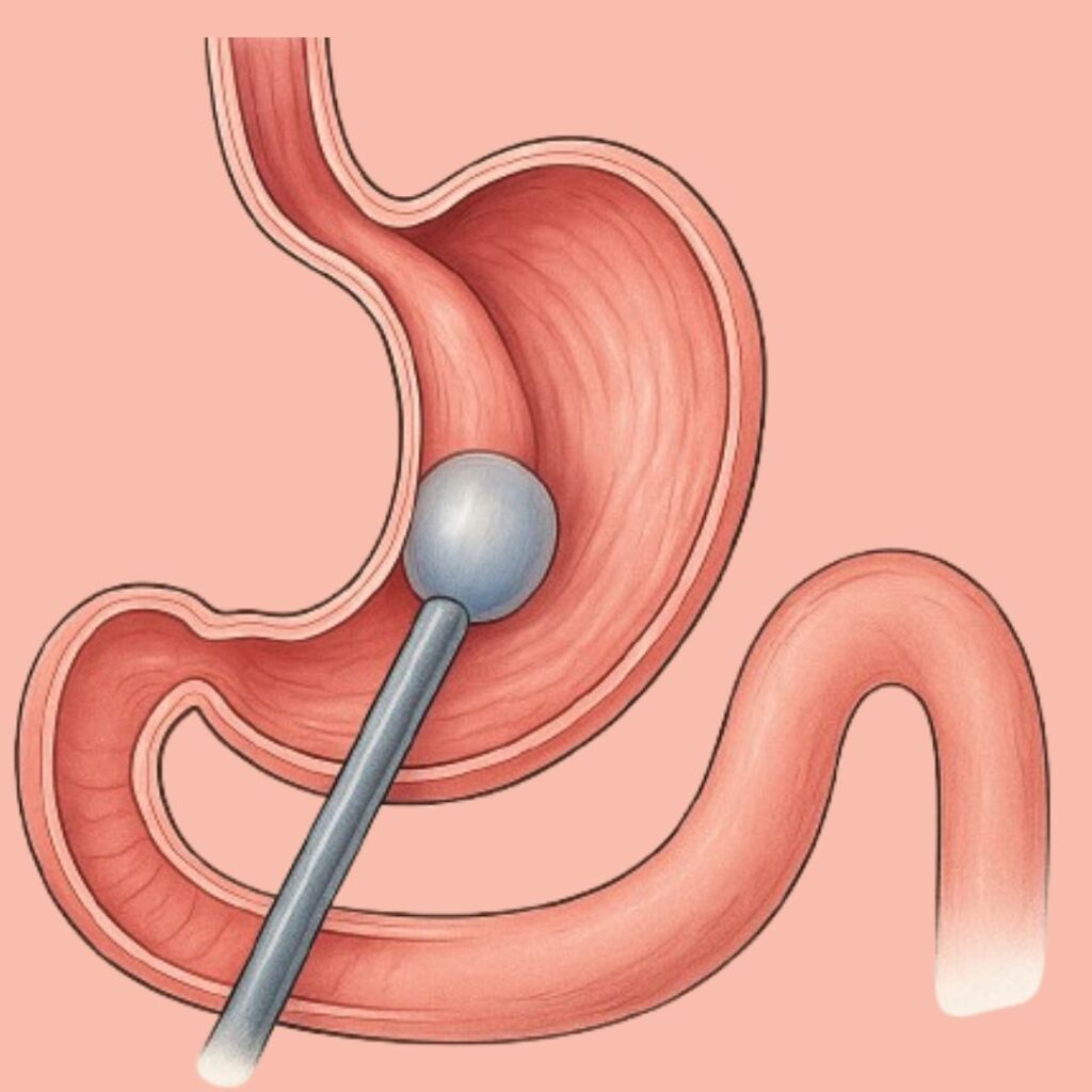 आहार नली का रास्ता चौड़ा करना (dilatation)